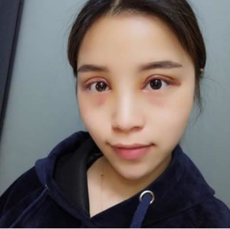 超声波双眼皮打败单眼皮的命运782 超声波双眼皮打败单眼皮的命运782