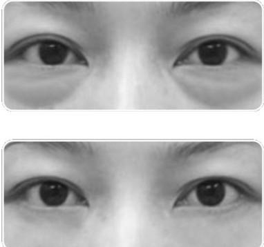 想去眼袋,请做超 声 波去眼袋 想去眼袋,请做超 声 波去眼袋