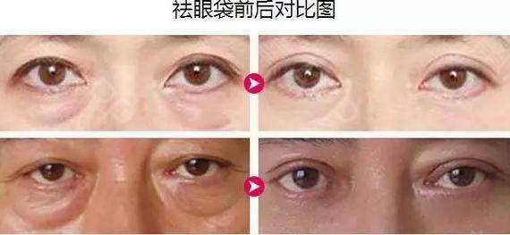 经常熬夜造成眼袋用超 声 波去眼袋解决! 经常熬夜造成眼袋用超 声 波去眼袋解决!