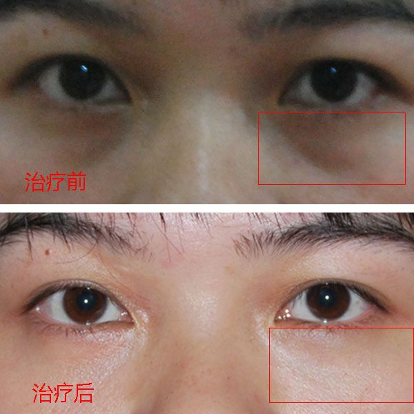 安全眼袋消除术——超声波去眼袋手术481 安全眼袋消除术——超声波去眼袋手术481