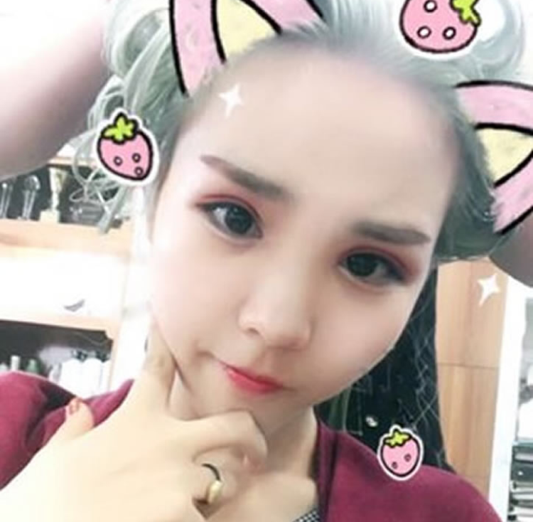 超声波双眼皮做出来的效果自然956 超声波双眼皮做出来的效果自然956
