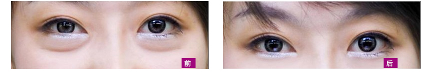还在使用错误的去眼袋方法吗？快来使用正确的超声波去眼袋吧184