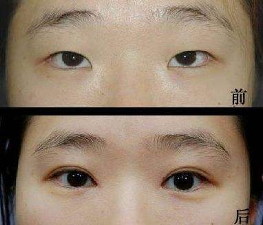 超声波双眼皮无痕自然的做出双眼皮352 超声波双眼皮无痕自然的做出双眼皮352