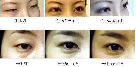 怎么做双眼 皮手术呢? 怎么做双眼 皮手术呢?