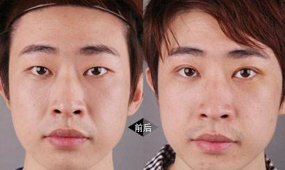 双眼皮整形,大家一起来看看吧726 双眼皮整形,大家一起来看看吧726