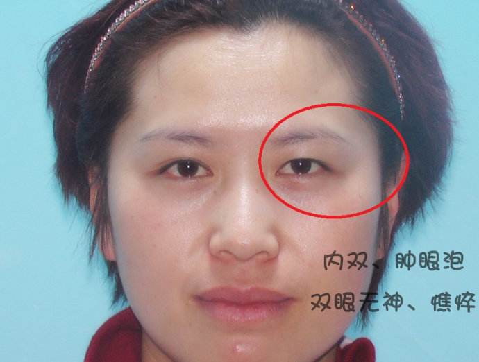 双眼皮整形,大家一起来看看吧726 双眼皮整形,大家一起来看看吧726