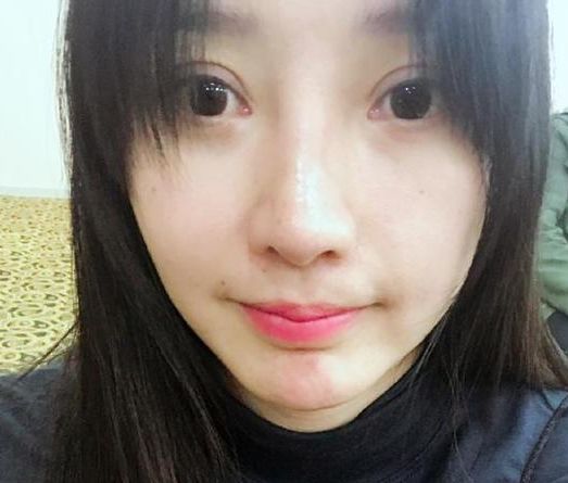 怎么样才能祛掉遗传性得大眼袋呢？去眼袋手术哪种好呢？
