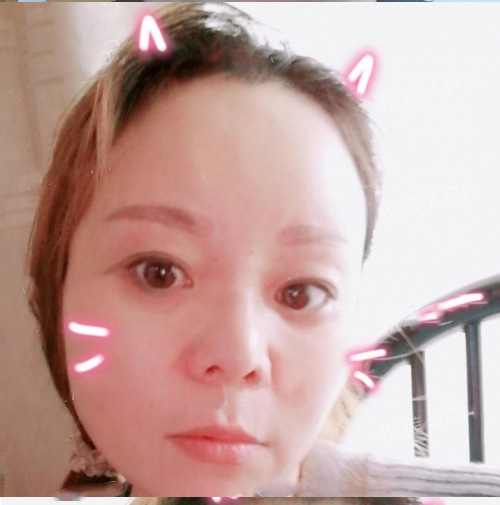 加了梁医生的微信以后我选择做超声波去眼袋250 加了梁医生的微信以后我选择做超声波去眼袋250
