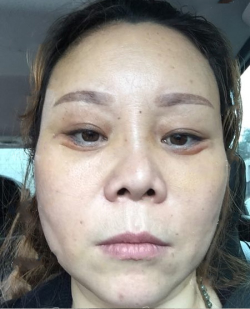 加了梁医生的微信以后我选择做超声波去眼袋250 加了梁医生的微信以后我选择做超声波去眼袋250