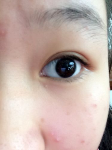 去眼袋手术后凹陷怎么办?780 去眼袋手术后凹陷怎么办?780