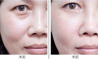 做le去眼袋手术后眼袋会再生吗? 做le去眼袋手术后眼袋会再生吗?