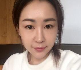 分享做完超声波去眼袋的喜悦536 分享做完超声波去眼袋的喜悦536