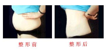 超声波减肥是相对来说很安全的吸脂减肥方式!946 超声波减肥是相对来说很安全的吸脂减肥方式!946