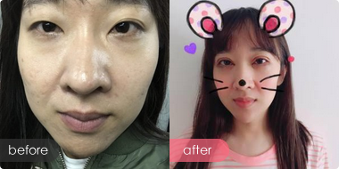 超声波双眼皮让“小窗”换成“大落地窗”108 超声波双眼皮让“小窗”换成“大落地窗”108