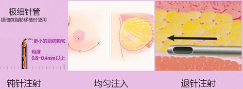隆胸手术修复的基本问题有哪些呢?171 隆胸手术修复的基本问题有哪些呢?171