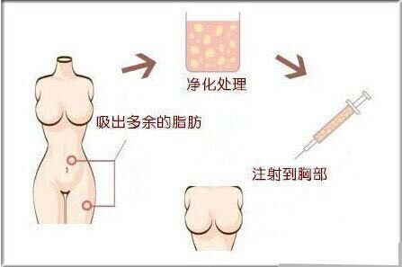 隆胸手术修复的基本问题有哪些呢?171 隆胸手术修复的基本问题有哪些呢?171