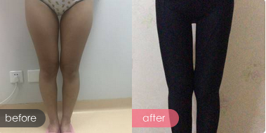 超 声 波减肥妙变铅笔腿 超 声 波减肥妙变铅笔腿