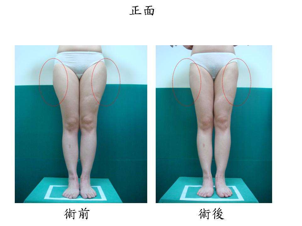 吸脂减肥瘦大腿有哪些问题呢?612 吸脂减肥瘦大腿有哪些问题呢?612
