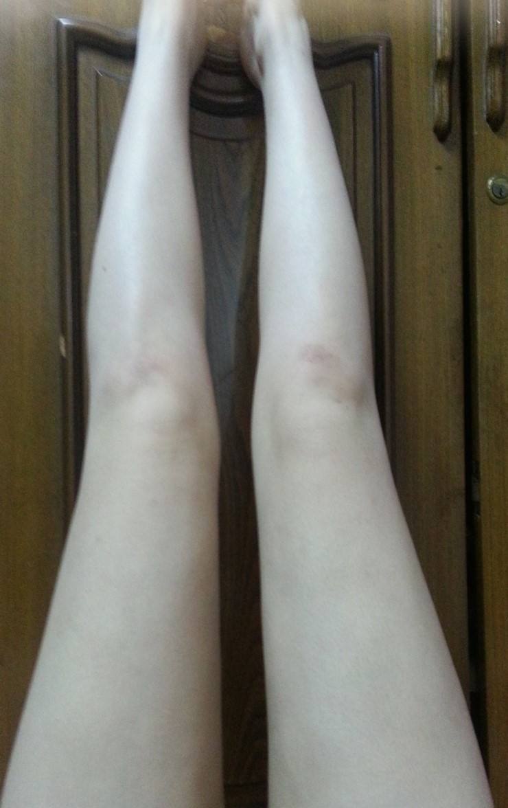 吸脂减肥瘦大腿有哪些问题呢?612 吸脂减肥瘦大腿有哪些问题呢?612