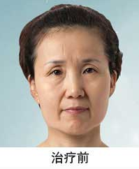 爱漂亮的奶奶做了彭氏童颜术变得年轻漂亮了758 爱漂亮的奶奶做了彭氏童颜术变得年轻漂亮了758