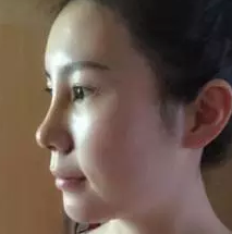 做不开刀隆鼻后的分享:鼻子的改变644 做不开刀隆鼻后的分享:鼻子的改变644