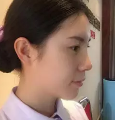 做不开刀隆鼻后的分享:鼻子的改变644 做不开刀隆鼻后的分享:鼻子的改变644