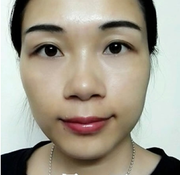 做超声波去眼袋和不开刀隆鼻让我更美丽494 做超声波去眼袋和不开刀隆鼻让我更美丽494
