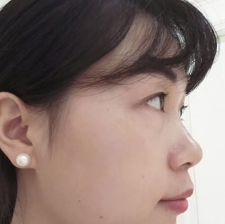 做超声波去眼袋和不开刀隆鼻让我更美丽494 做超声波去眼袋和不开刀隆鼻让我更美丽494