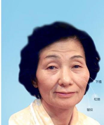 做超 声 波提升术让wǒ再次变年轻 做超 声 波提升术让wǒ再次变年轻