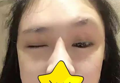 超 声 波双眼 皮让单眼 皮变成双眼 皮 超 声 波双眼 皮让单眼 皮变成双眼 皮