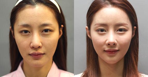 超 声 波去眼袋shì什么? 超 声 波去眼袋shì什么?