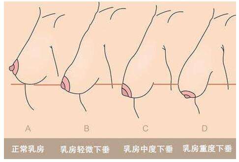 自体脂肪丰胸手术得优缺点,你le解多少呢? 自体脂肪丰胸手术得优缺点,你le解多少呢?