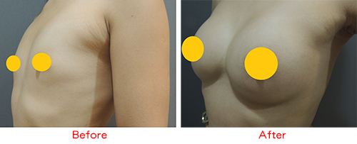 超声波自体脂肪丰胸手术帮各位宝妈解决产后乳房各种“疑难杂症”956