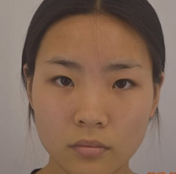 我和我的闺蜜们做超声波双眼皮的故事855 我和我的闺蜜们做超声波双眼皮的故事855