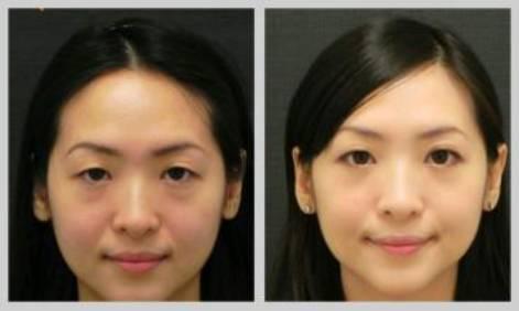 超声波去眼袋轻松消除眼袋不反弹！美的就是你！424