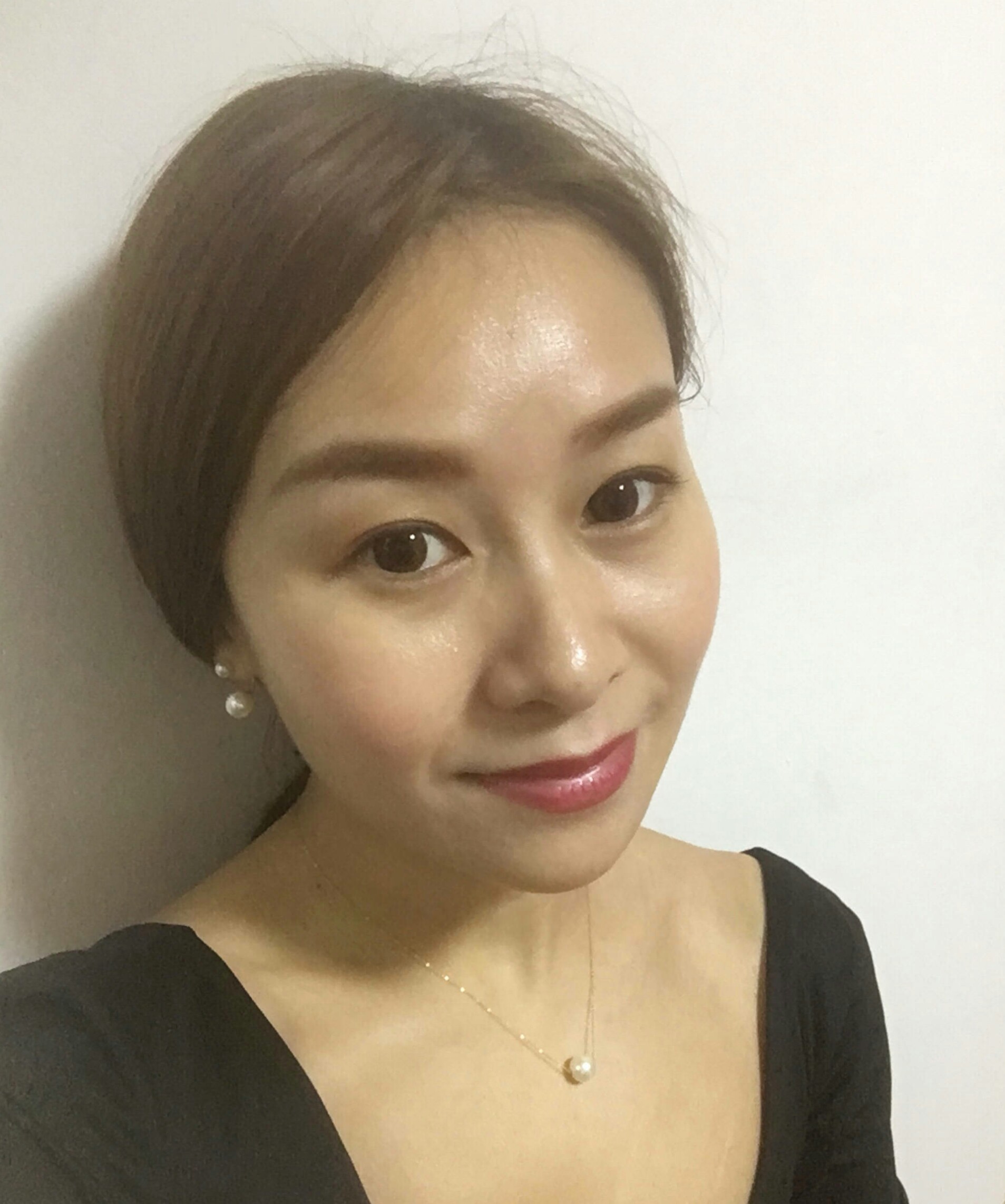 为了自己婚礼上的美好形象，我做了超声波祛眼袋的手术996