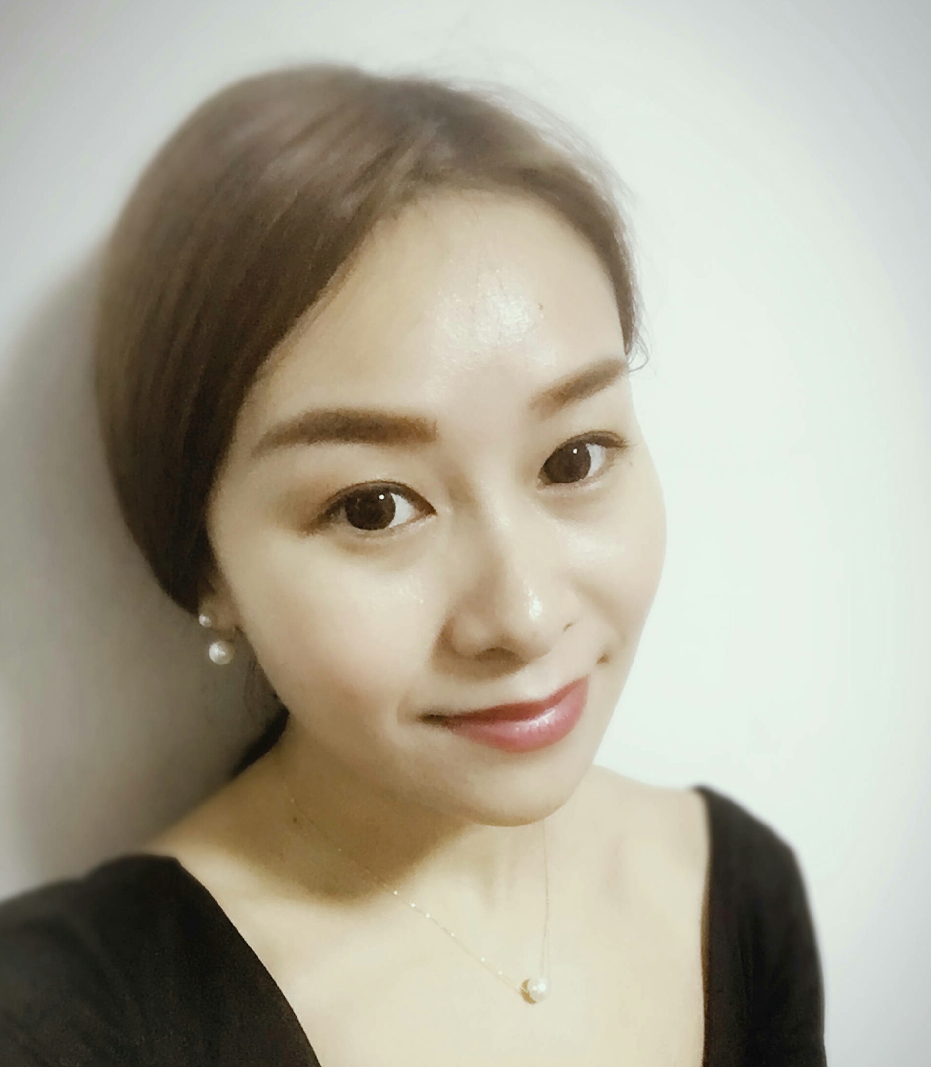为了自己婚礼上的美好形象，我做了超声波祛眼袋的手术996