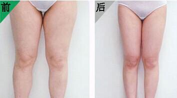 吸脂减肥要用好得方法才更好，比方说超 声 波减肥！