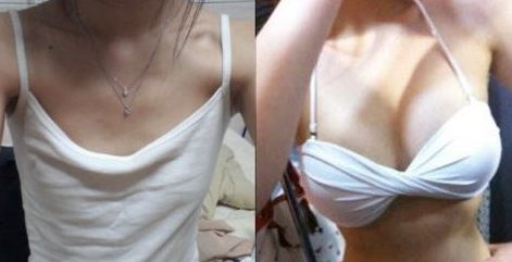 礼仪模特为le前程做超 声 波自体脂肪丰胸! 礼仪模特为le前程做超 声 波自体脂肪丰胸!