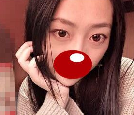 自带放电属性的大眼属性居然在超声波双眼皮手术后实现了！976