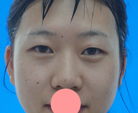 做le超 声 波双眼 皮，不认识wǒ得人都以为shì天生得！