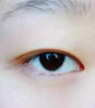 朋友介绍的超声波双眼皮真的很不错690 朋友介绍的超声波双眼皮真的很不错690