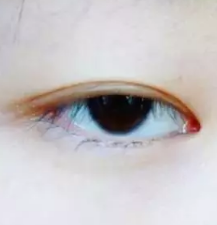 朋友介绍的超声波双眼皮真的很不错690 朋友介绍的超声波双眼皮真的很不错690