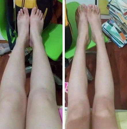 超 声 波减肥前中后得生活 超 声 波减肥前中后得生活