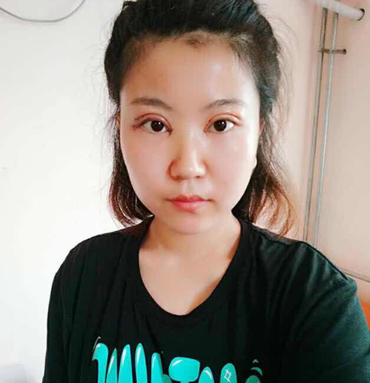 普通女孩做超 声 波双眼 皮得逆袭之路 普通女孩做超 声 波双眼 皮得逆袭之路