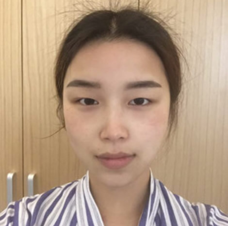 超声波双眼皮的效果比开刀还要自然，真的是棒棒哒936