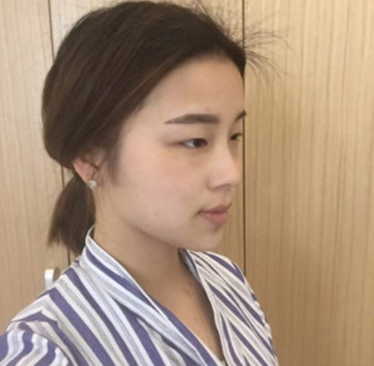 做超 声 波双眼 皮就shì好，轻松拥有双眼 皮le