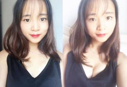 美丽印象来自超声波自体脂肪丰胸手术025 美丽印象来自超声波自体脂肪丰胸手术025