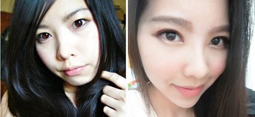 超声波双眼皮手术优势在哪里292 超声波双眼皮手术优势在哪里292