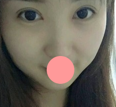我也赶个潮流，做个超声波双眼皮手术！分享效果啦~~297